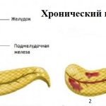 1) Healthy pancreas. 2) Inflammation of the pancreas. 