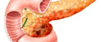 535-pancreatitis.jpg