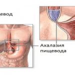 Ахалазия пищевода