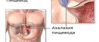 Esophageal achalasia