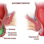 Анатомия геморроя