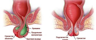 Анатомия геморроя