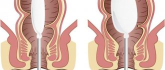 Anorectal manometry