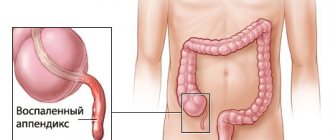 appendicitis