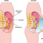 abdominal ascites