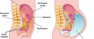 abdominal ascites