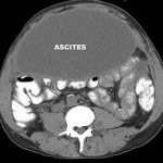 ascites1