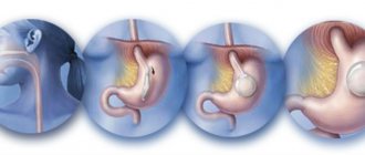 Gastric ballooning