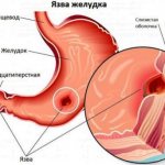 Боль в боку и рвота могут быть признаками язвы