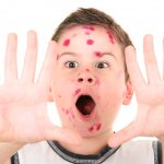 Why is chickenpox dangerous in children?