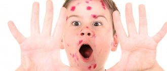 Why is chickenpox dangerous in children?