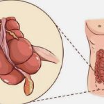 Что делать, если лопнул аппендицит: какие будут последствия