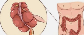 What to do if appendicitis bursts: what are the consequences?