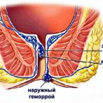 Что такое геморрой