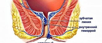 Что такое геморрой