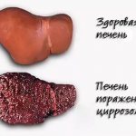 cirrhosis of the liver