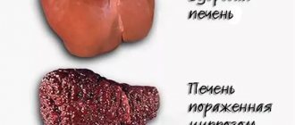 cirrhosis of the liver