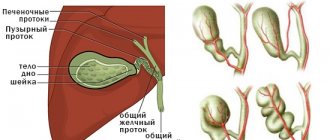 Gallbladder deformity treatment