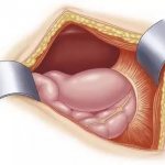 Diaphragmatic hernia