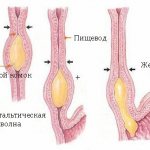 Esophageal dyskinesia