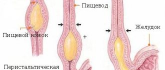 Esophageal dyskinesia