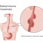 Esophageal diverticulum