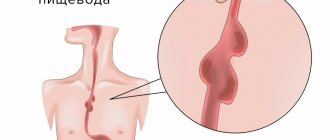 Esophageal diverticulum