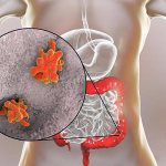 Dysenteric amoebas in the large intestine