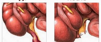 Before and after appendectomy