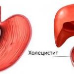 duodenitis and cholecystitis