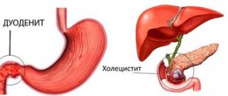 duodenitis and cholecystitis