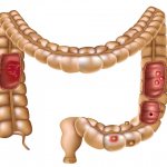 Duodenitis