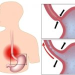 The movement of gastric contents is normal and with reflux.