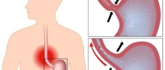 The movement of gastric contents is normal and with reflux.