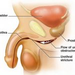 Effective treatment of urethral stricture