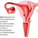 Endometriosis is a possible cause of burning in the lower abdomen