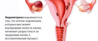 Эндометриоз – возможная причина жжения внизу живота