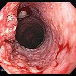 Endoscopic picture of adenocarcinoma