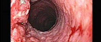 Endoscopic picture of adenocarcinoma