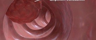 Endoscopic polypectomy of the intestines and stomach