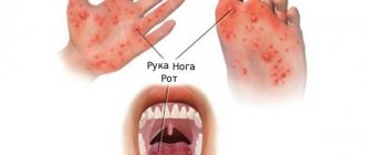 Enteroviral pemphigus