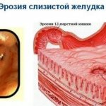 Erosive gastritis