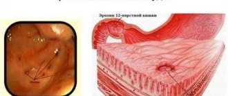 Erosive gastritis