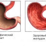 Gastritis of atrophic type