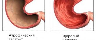 Gastritis of atrophic type