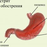 Гастрит во время обострения