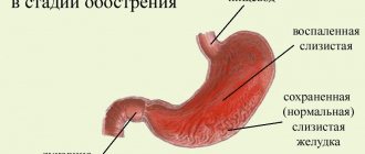 Гастрит во время обострения