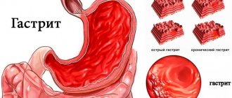 Gastritis