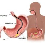 Gastroscopy