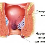 Геморроидальные шишки